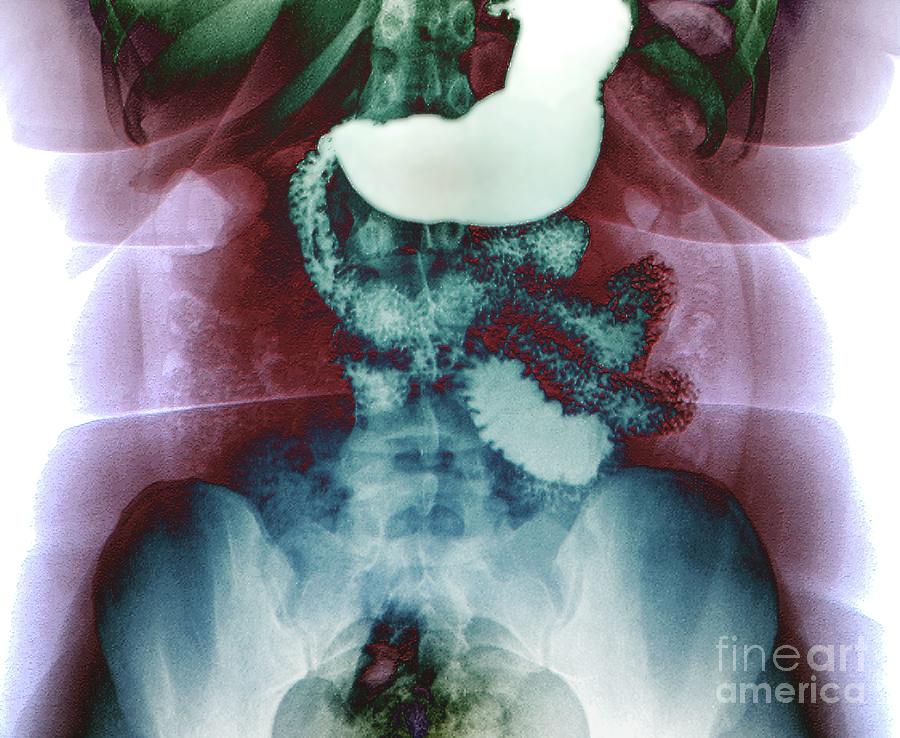 Oeso-gastrointestinal Duodenal Transit #3 Photograph by Zephyr/science Photo Library