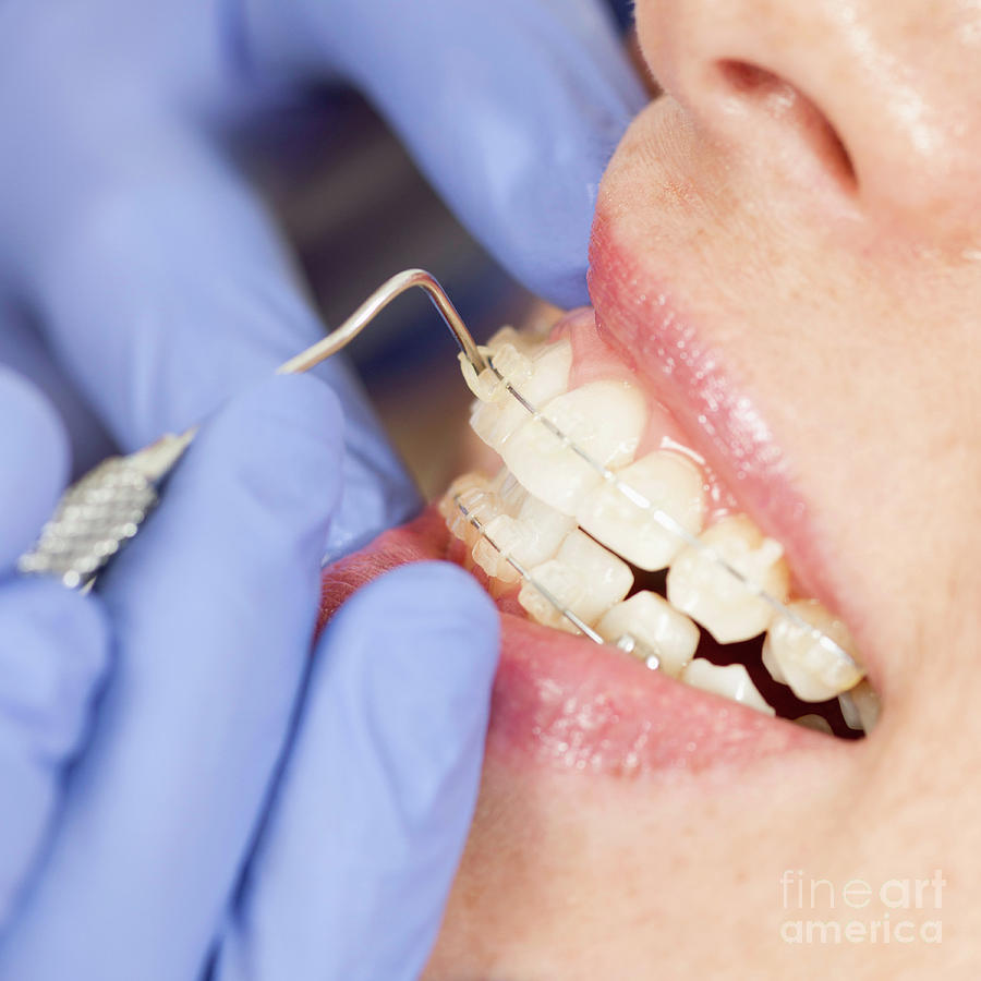 Braces Photograph - Orthodontist Tightening Braces #3 by Microgen Images/science Photo Library