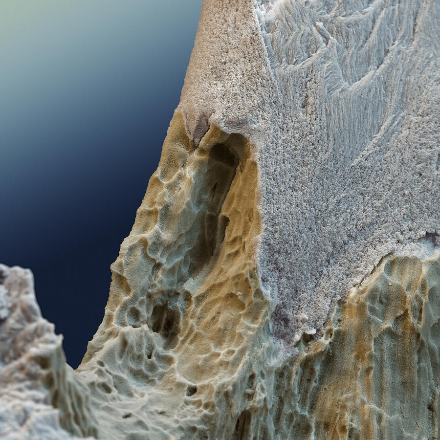 Osteoporotic Bone #3 Photograph by Meckes/ottawa