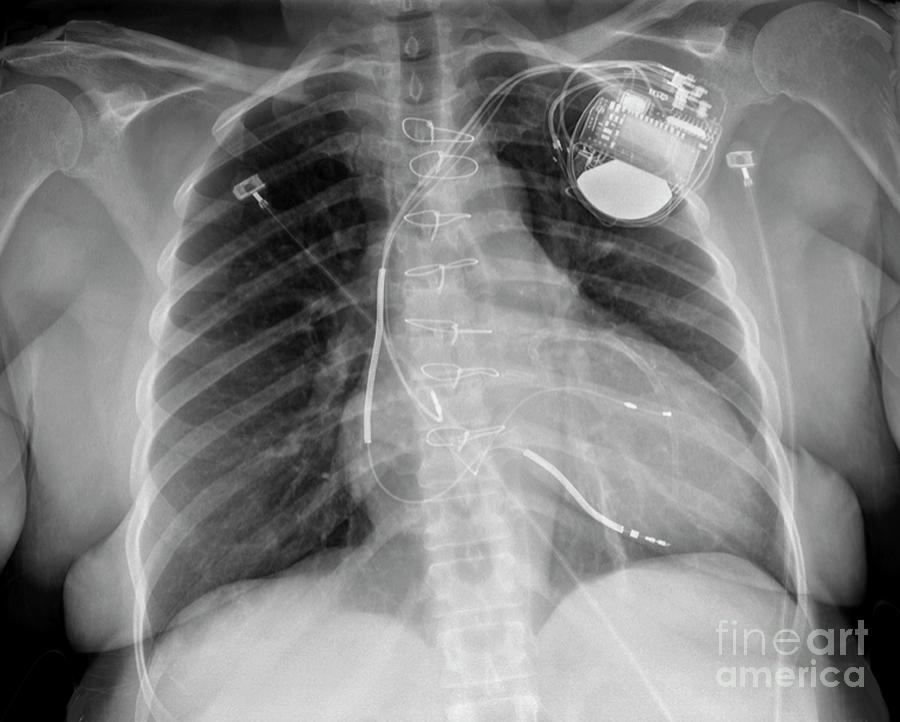 Pacemaker For Heart Failure Photograph by Zephyr/science Photo Library