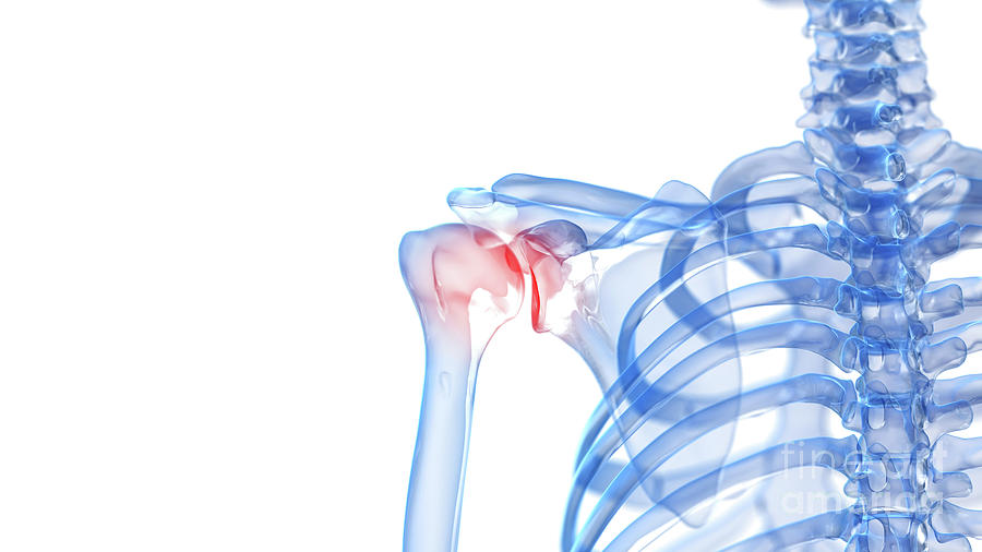 Painful Shoulder #3 Photograph by Sebastian Kaulitzki/science Photo Library