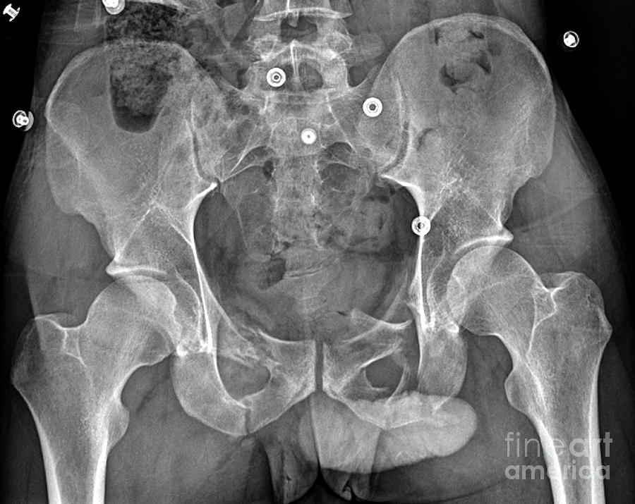 Pelvic Fracture Photograph by Zephyr/science Photo Library | Fine Art ...