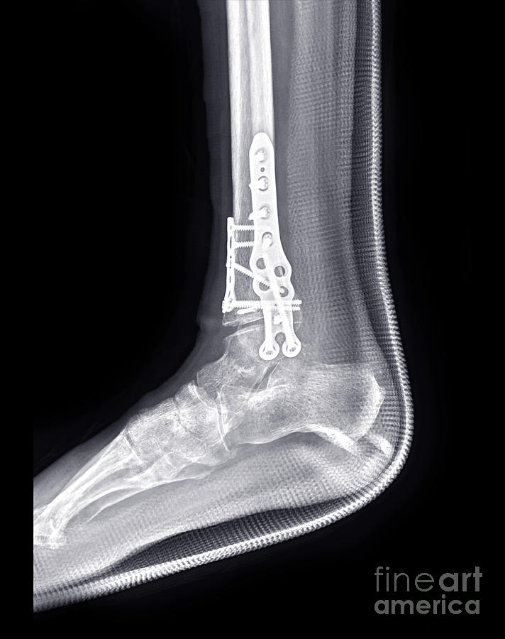 Ankle Fracture Treatment - Moore Foot & Ankle