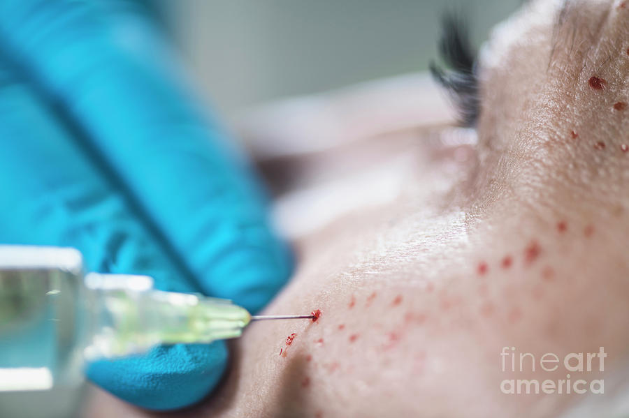 Prp Photograph - Platelet-rich Plasma Facial Treatment #3 by Microgen Images/science Photo Library