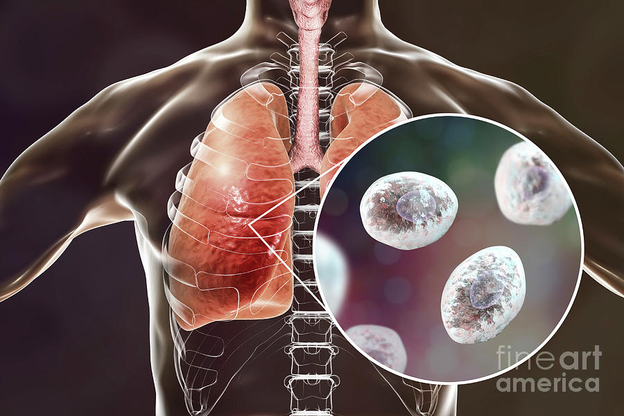 Pneumocystis Pneumonia 3 Photograph By Kateryna Konscience Photo Library Pixels 