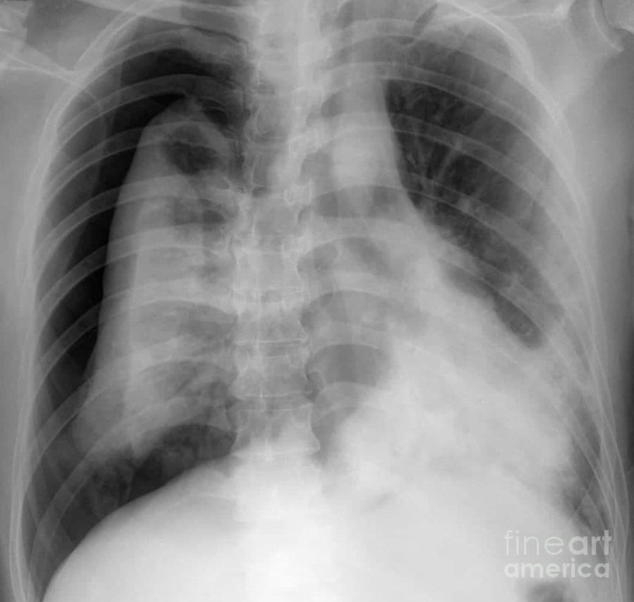 Pneumothorax Photograph by Rajaaisya/science Photo Library - Fine Art ...