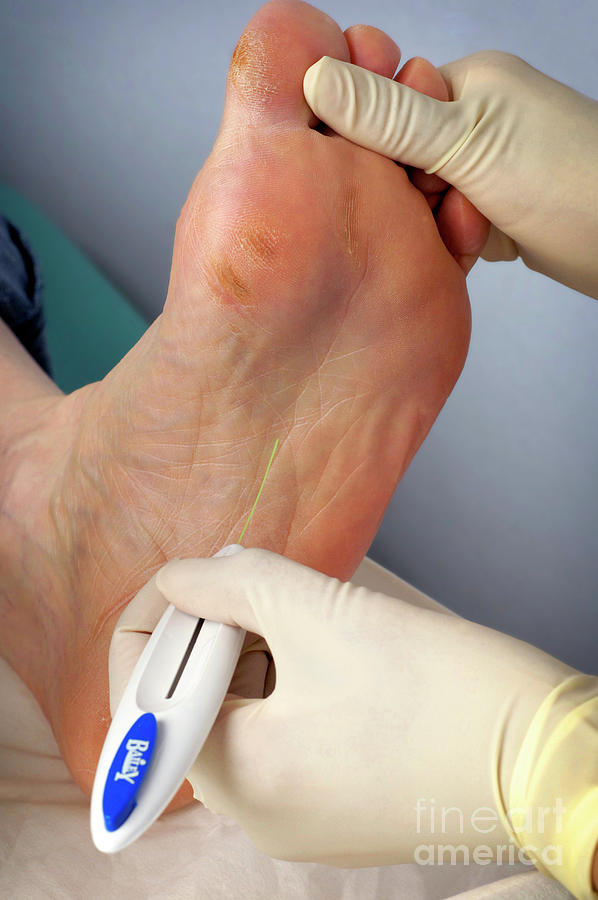 Podiatry Treatment #3 Photograph by Medicimage / Science Photo Library
