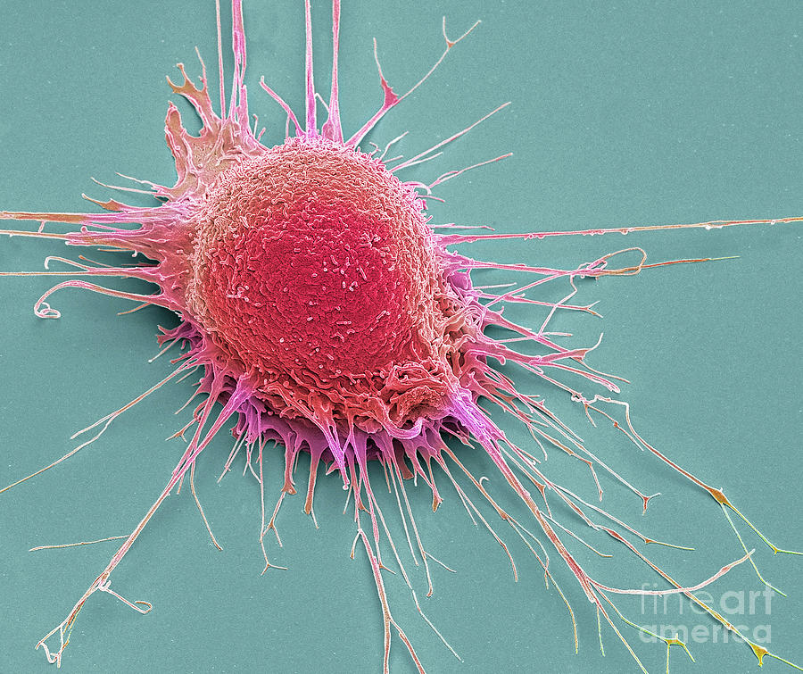 Prostate Cancer Cell Photograph by Steve Gschmeissner/science Photo ...