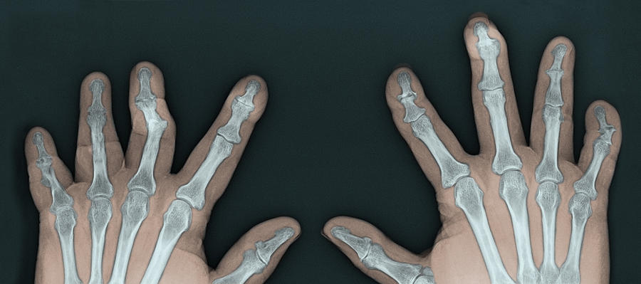 Psoriatic Arthritis, X-ray Photograph by Steven Needell