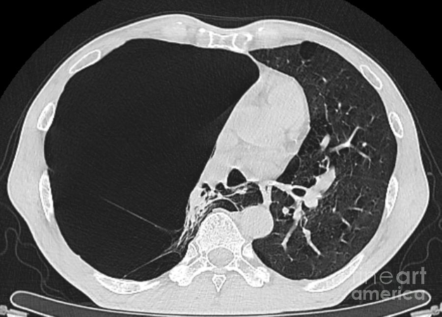 Pulmonary Giant Bulla #3 Photograph by Rajaaisya/science Photo Library ...