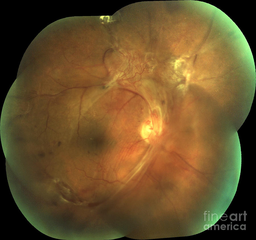 Retina Damage From Diabetes #3 Photograph by Alan Frohlichstein/science Photo Library