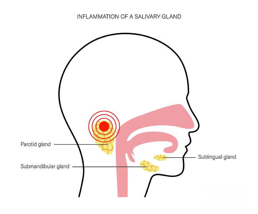 Salivary Gland Inflammation Photograph by Pikovit / Science Photo ...