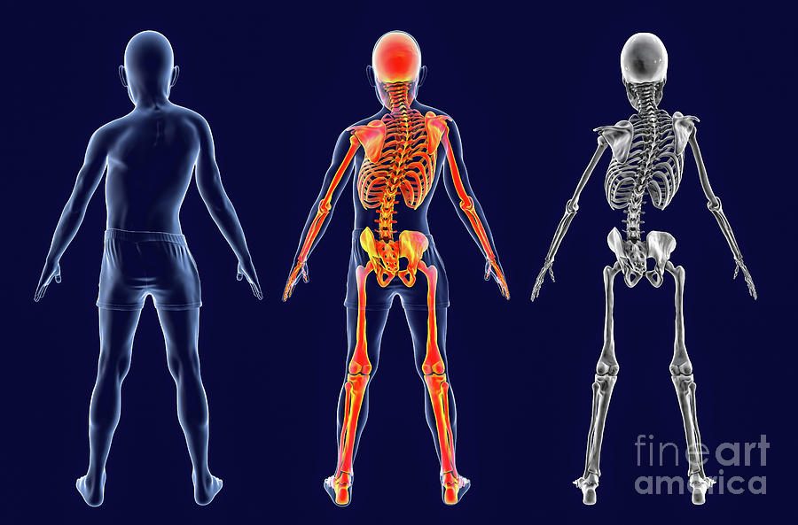 Scoliosis Of The Spine Photograph by Kateryna Kon/science Photo Library ...