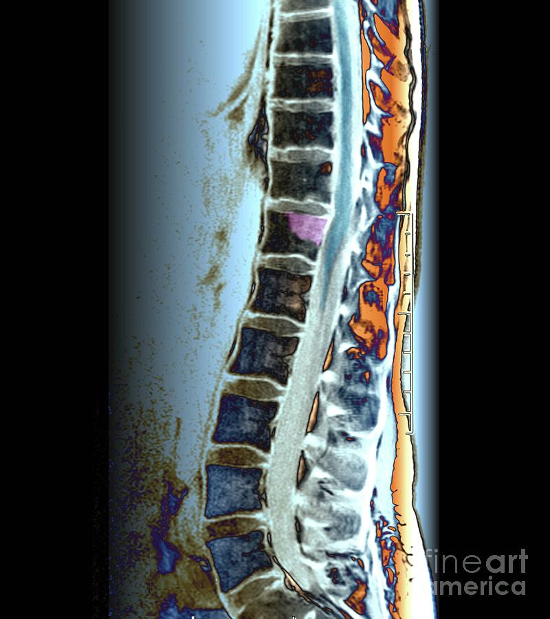 Secondary Bone Cancer In The Spine #3 Photograph by Zephyr/science Photo Library