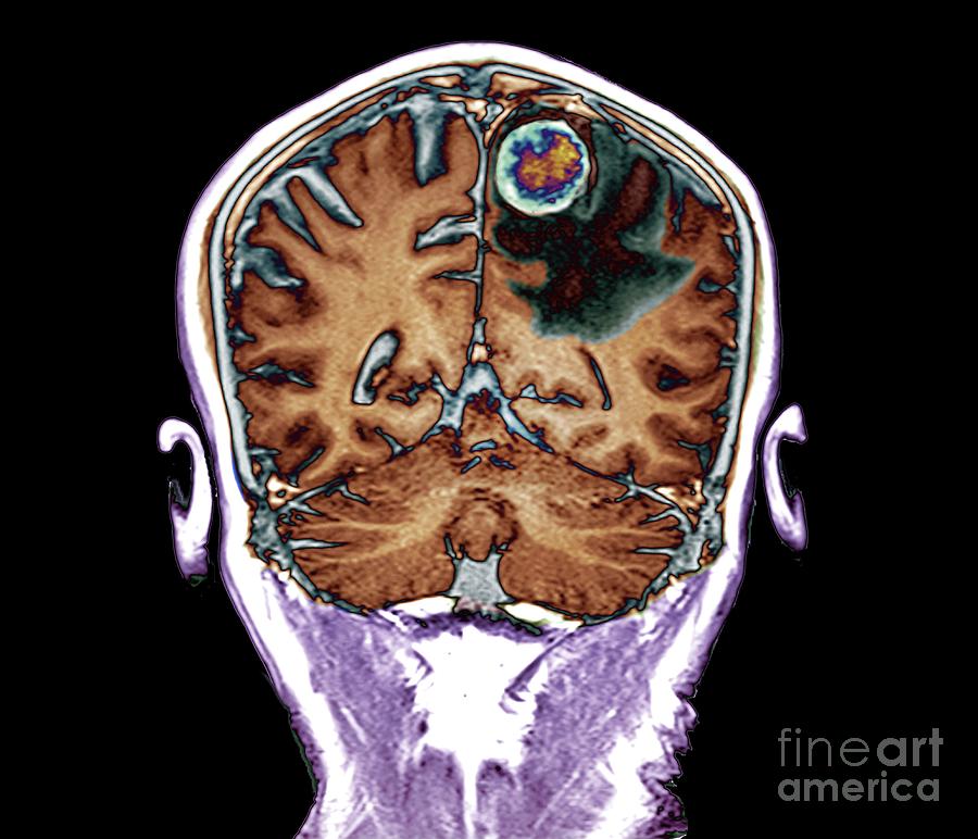 secondary-brain-cancer-photograph-by-zephyr-science-photo-library