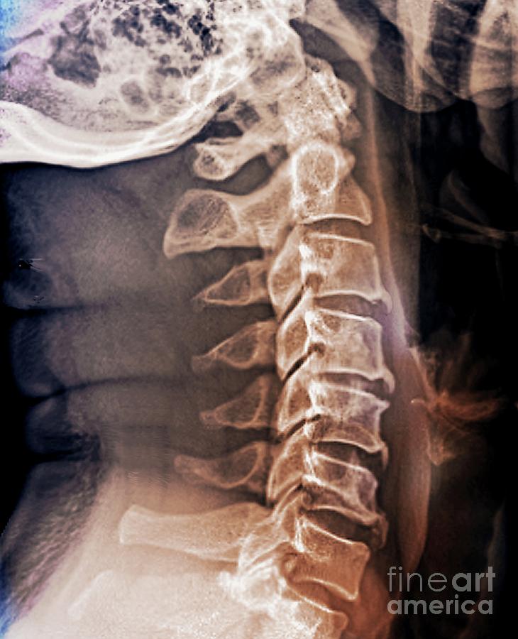 Male Photograph - Spinal Arthritis #3 by Zephyr/science Photo Library