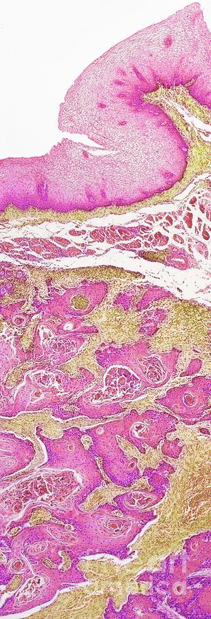 Squamous Cell Carcinoma Of The Vulva Photograph By Steve Gschmeissner