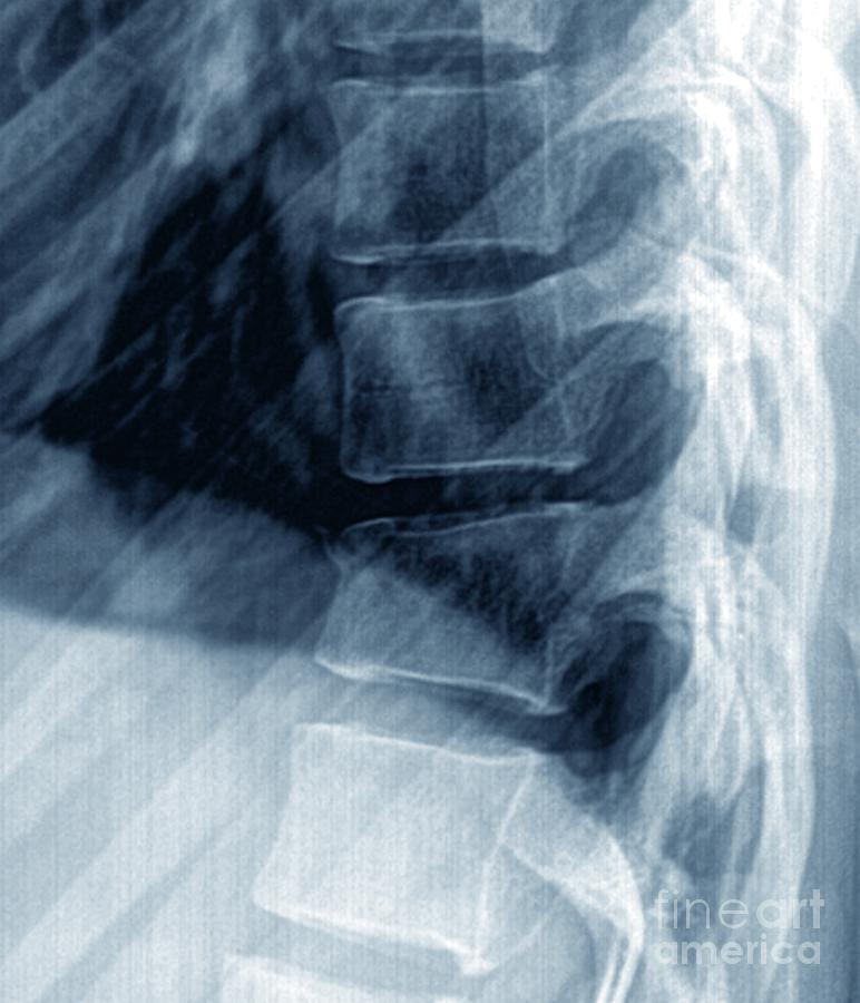 Thoracic Spine Fracture Photograph By Zephyr/science Photo Library | Pixels