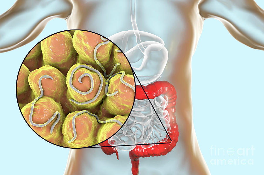 Threadworm Infection Photograph by Kateryna Kon/science Photo Library