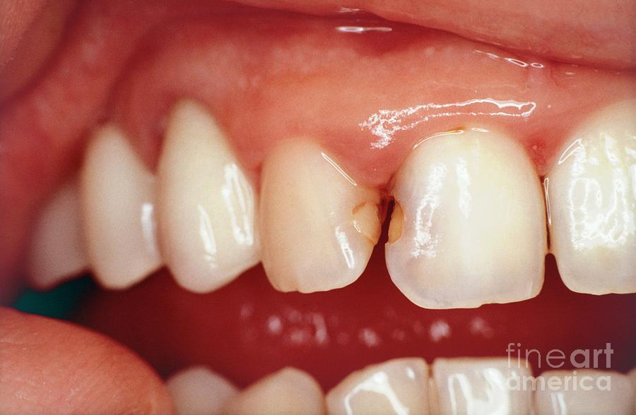 Tooth Decay #3 Photograph by Cnri/science Photo Library