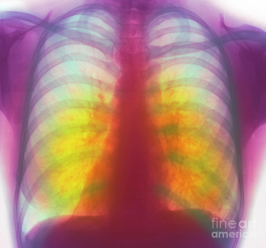 Tuberculosis X-ray #3 by Simon Fraser/science Photo Library