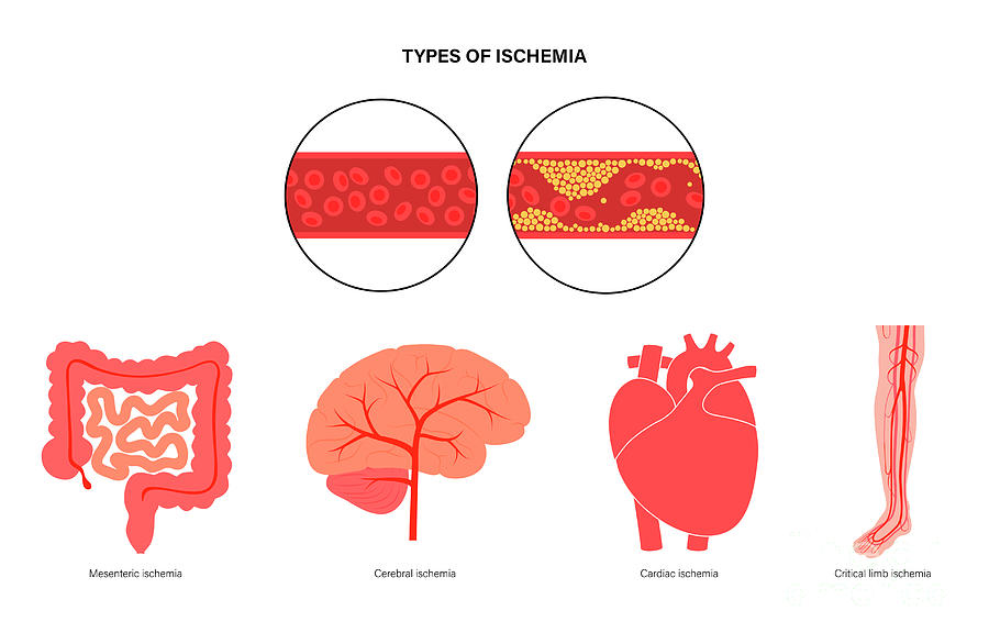 Types Of Ischaemic #3 Photograph by Pikovit / Science Photo Library ...