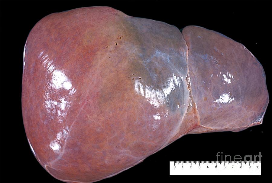 Unhealthy Human Liver #3 Photograph by Jose Calvo / Science Photo Library