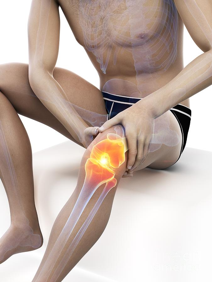 3d Photograph - Knee Pain #31 by Sebastian Kaulitzki/science Photo Library