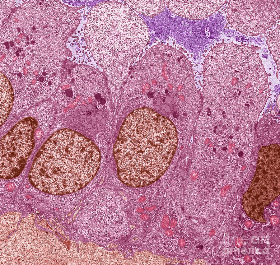 Breast Cancer #32 Photograph by Steve Gschmeissner/science Photo Library
