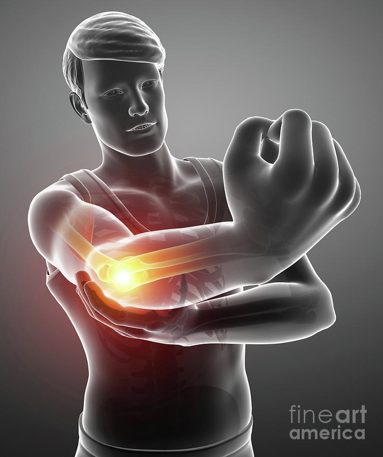 Elbow Photograph - Man With Elbow Pain #34 by Pixologicstudio/science Photo Library