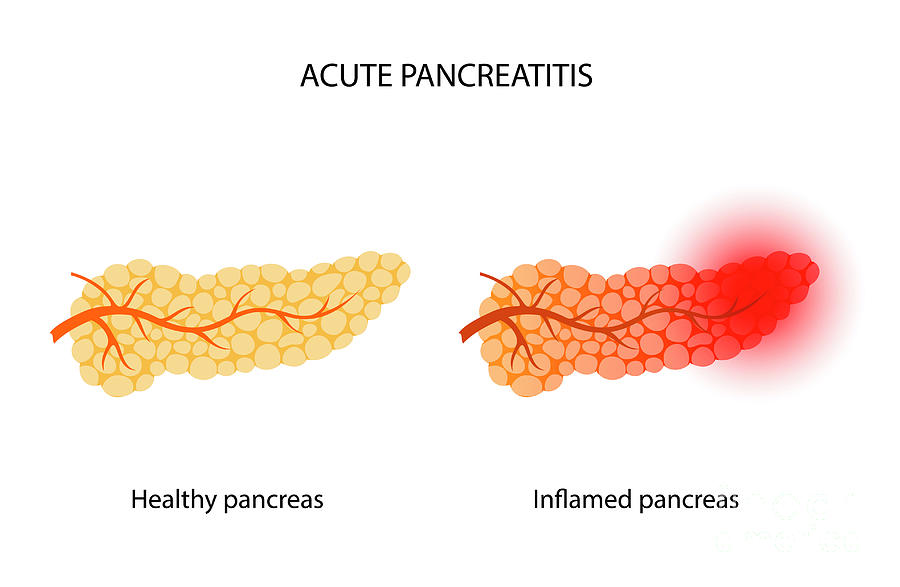 Acute Pancreatitis #4 Photograph by Pikovit / Science Photo Library