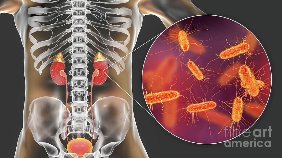 Acute Pyelonephritis Caused By E Coli Photograph By Kateryna Kon