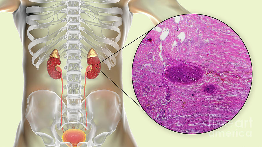 Acute Pyelonephritis Photograph by Kateryna Kon/science Photo Library ...