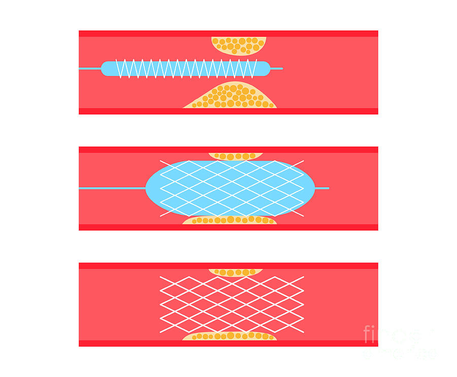 Angioplasty Photograph By Pikovit Science Photo Library Pixels 9253