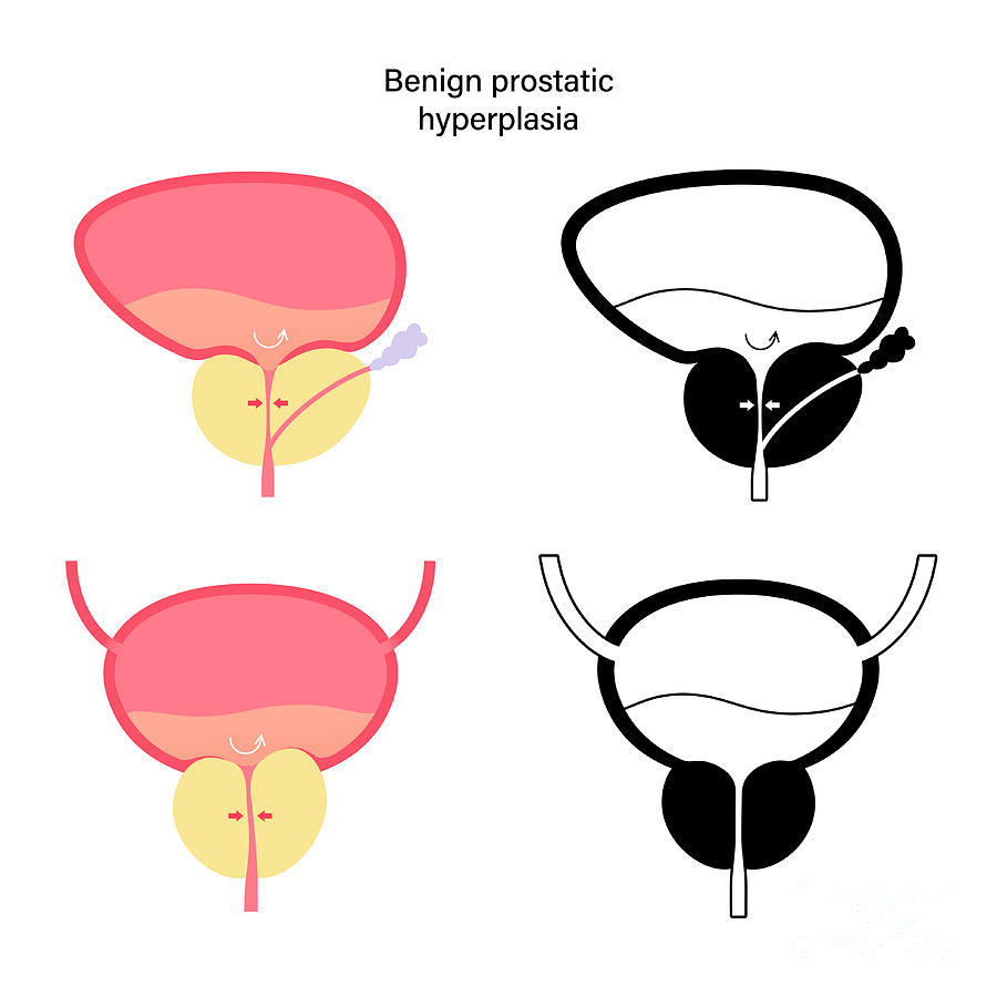 Benign Prostatic Hyperplasia Photograph By Pikovit Science Photo Hot