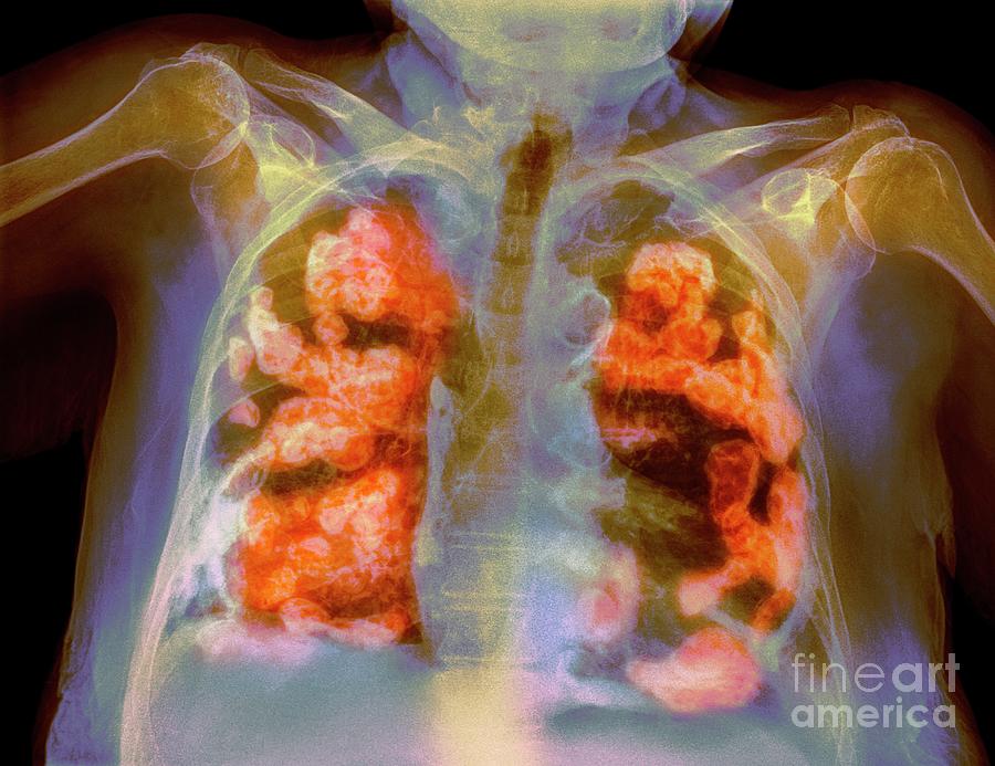 Bilateral Pleural Calcification #4 Photograph by Science Photo Library