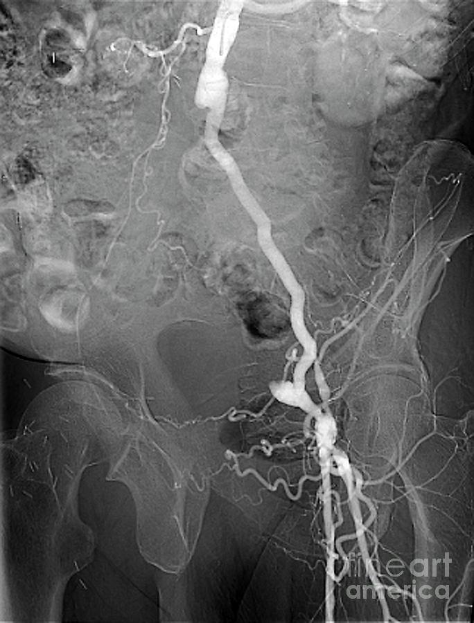 Blocked Pelvic Artery #4 Photograph by Zephyr/science Photo Library
