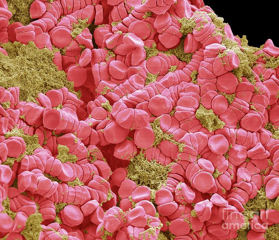 Blood Clot Photograph by Steve Gschmeissner/science Photo Library ...