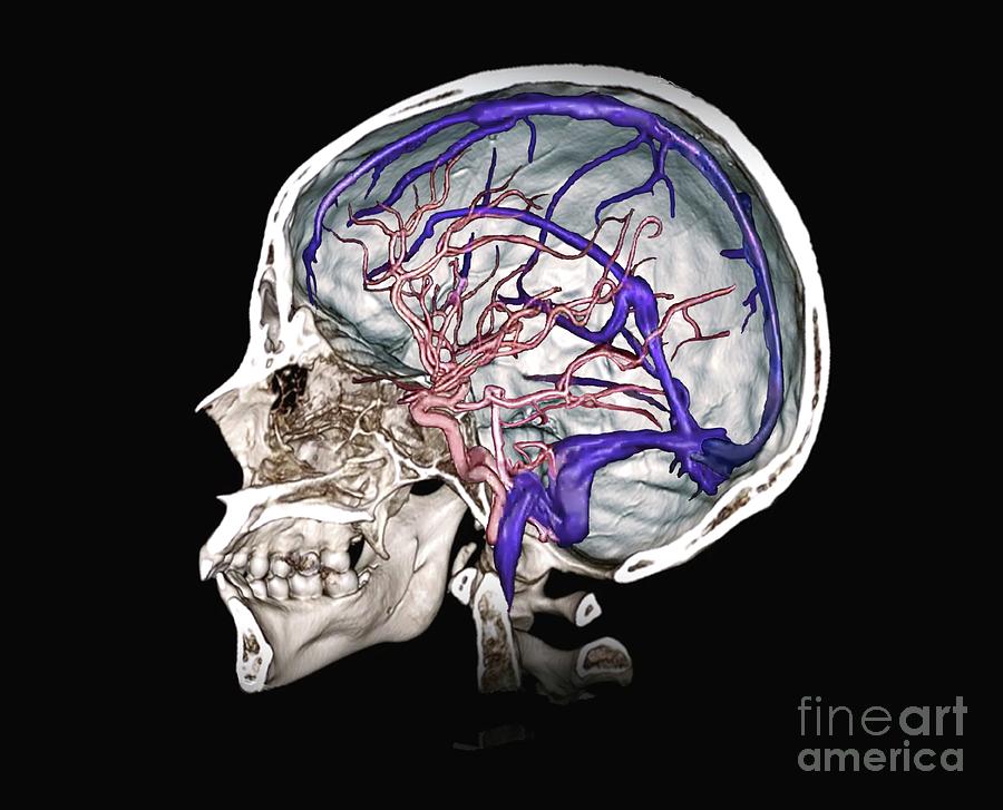 Brain Arteries And Venous Sinuses #4 Photograph by Zephyr/science Photo Library