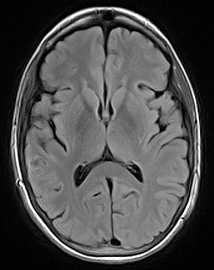 Brain Cancer Treated, Mri #4 Photograph by Steven Needell