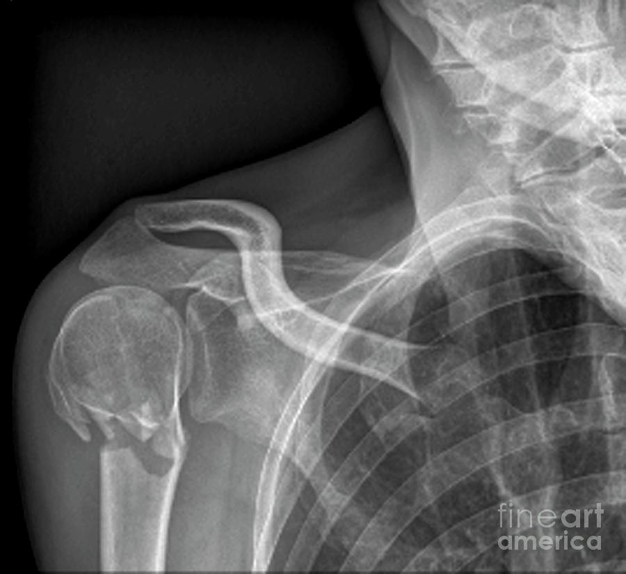 Broken Upper Arm Bone #4 Photograph by Zephyr/science Photo Library