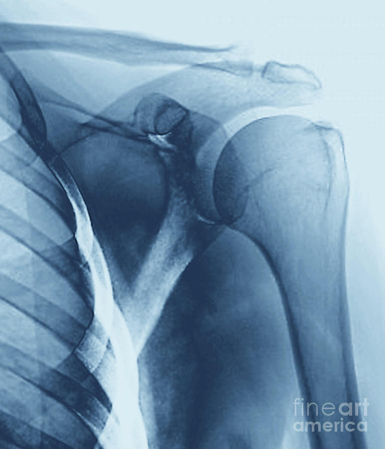 Calcific Tendinitis #4 Photograph by Zephyr/science Photo Library