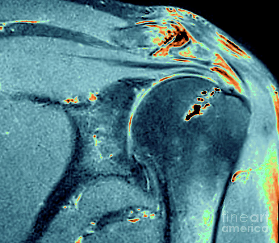 Calcified Tendinitis #4 Photograph by Zephyr/science Photo Library