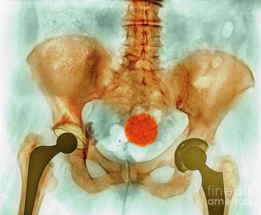 Calcified Uterine Fibroid #4 Photograph by Science Photo Library