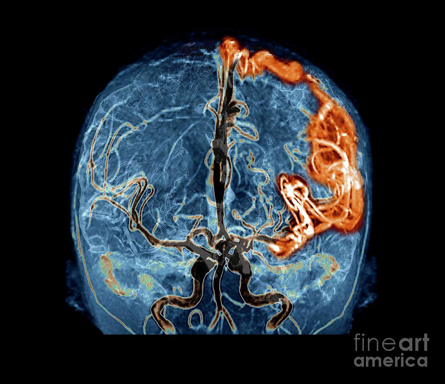 Cerebral Arteriovenous Malformation #4 Photograph by Zephyr/science Photo Library