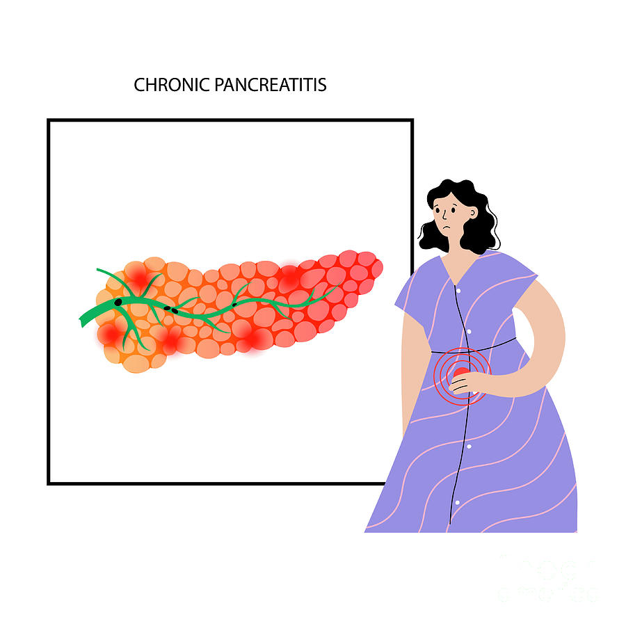 Chronic Pancreatitis #4 Photograph by Pikovit / Science Photo Library