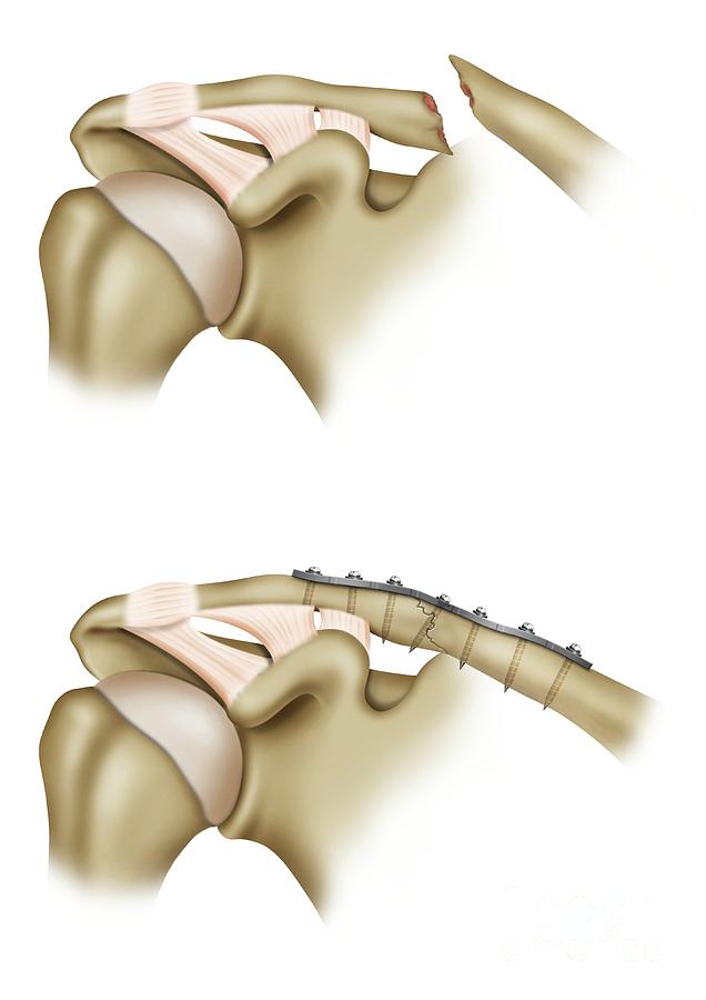 Clavicle Fracture Repair Surgery Photograph by Maurizio De Angelis ...