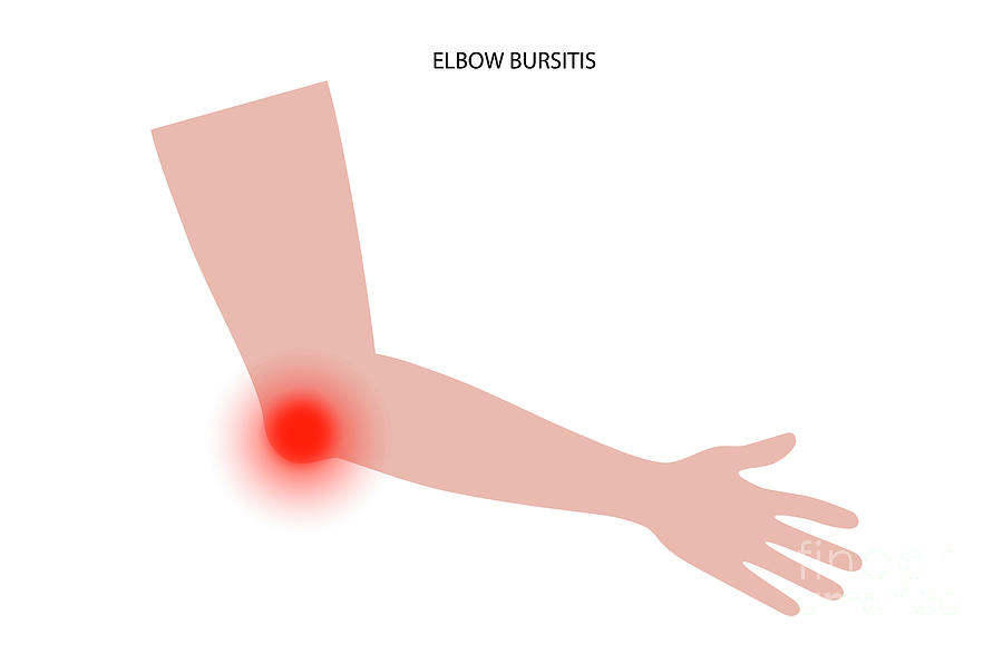 Elbow Bursitis Photograph by Pikovit / Science Photo Library - Pixels