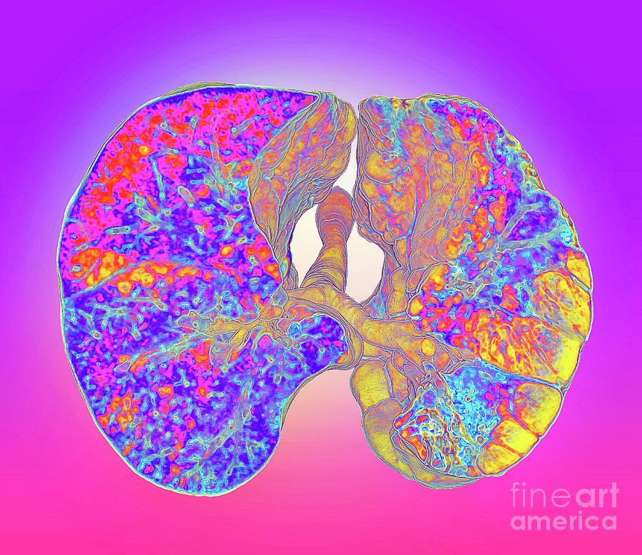 Emphysema Lung Disease Photograph By K H Fung Science Photo Library Fine Art America