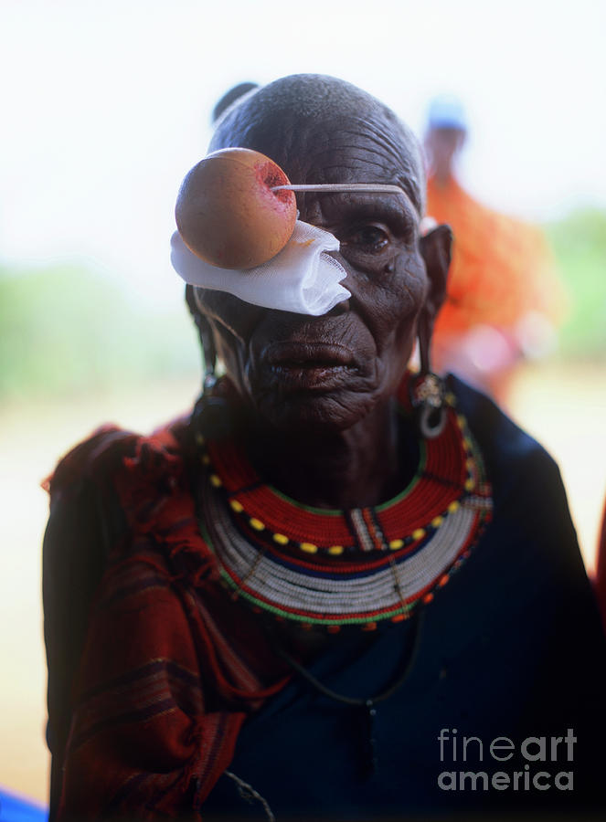 Eye Surgery Patient #4 Photograph by Jason Kelvin/science Photo Library